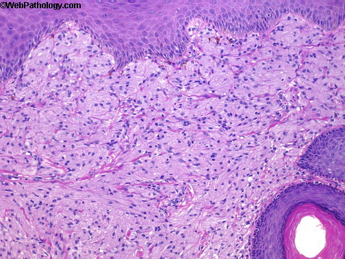 Scrotum_Granular Cell Tumor2.jpg
